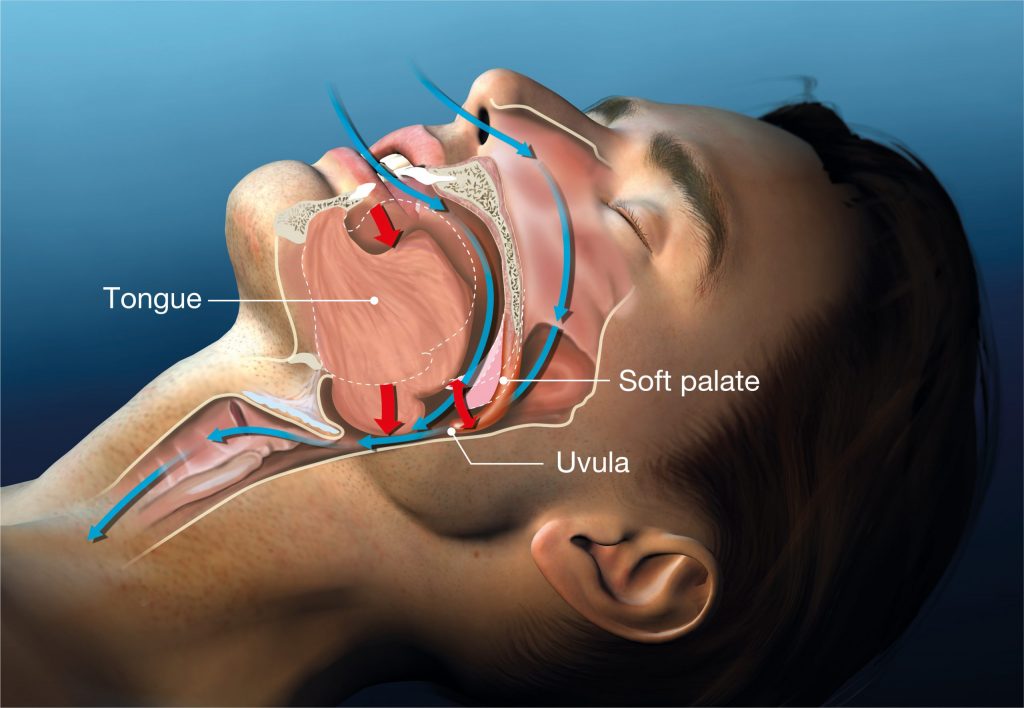 What is Sleep Apnea?