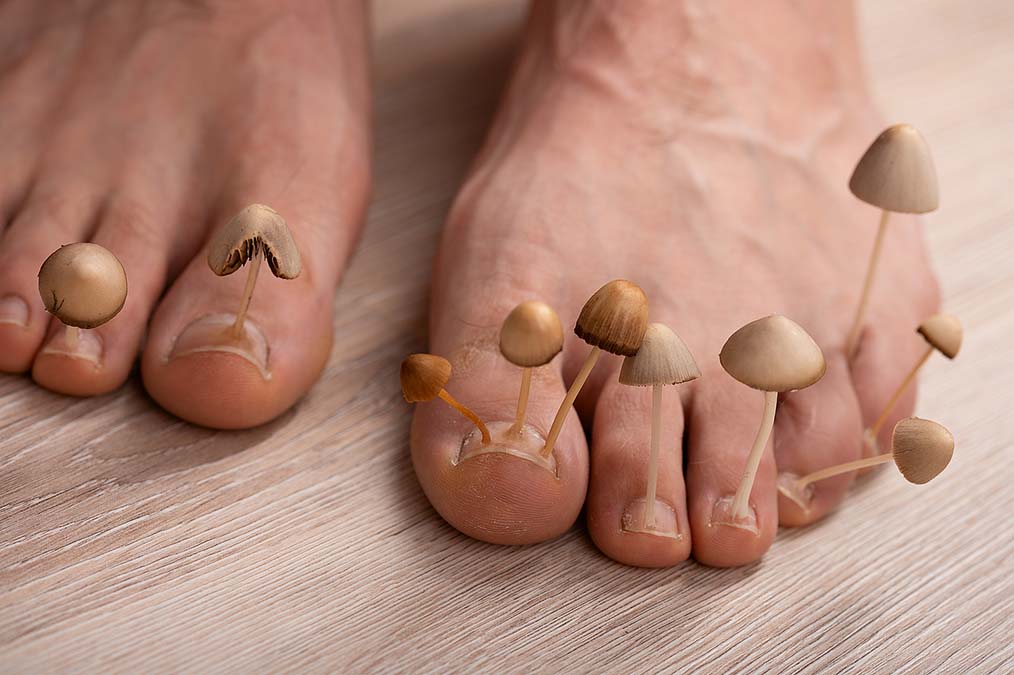 Healing Nail Fungus Your 1 Hindrance Healing-Nail-Fungus-Your-1-Hindrance