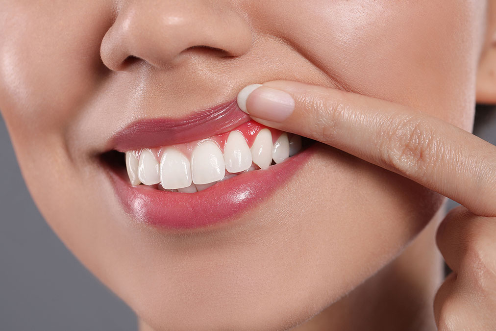 How Gum Disease Causes Stroke and How to Prevent it how gum disease causes stroke and how to prevent it