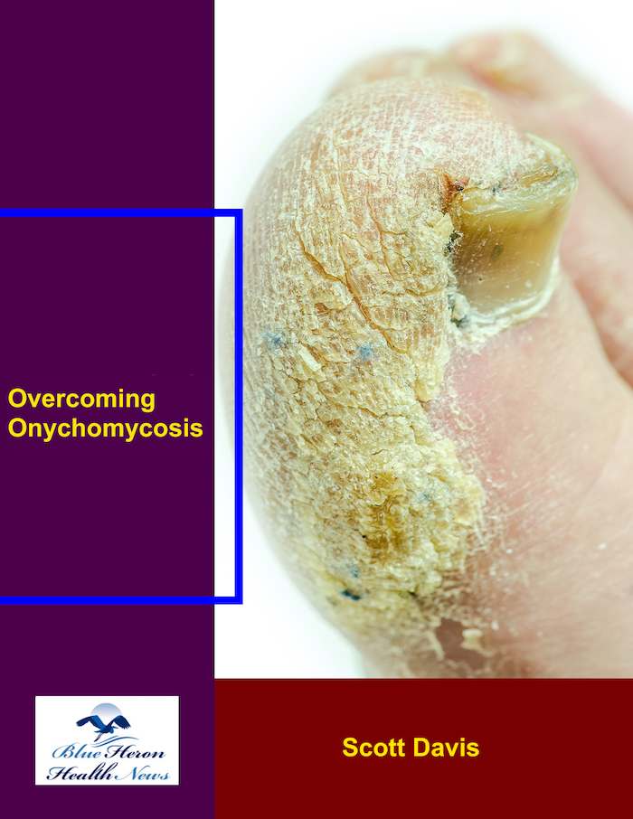 Overcoming Onychomycosis™ Reviews Scott Davis (Buyer Alert 2024)